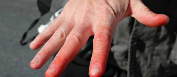 Перша допомога при обмороженнях: ступені та ознаки обмороження, як надати допомогу Перша допомога при обмороженнях: ступені та ознаки обмороження, як надати допомогу